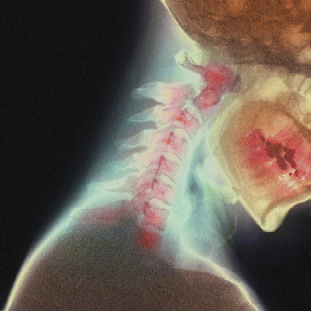 Broken Neck - Beverly Hills Chiropractic